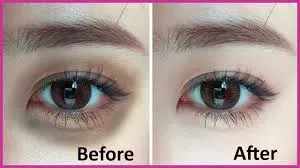Anti Dark Circle Treatment service image