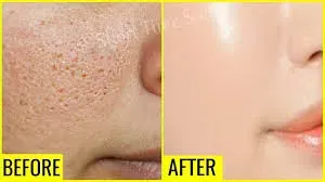 Anti Open Pore Treatment service image