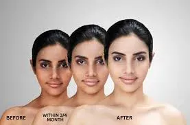 Skin Lightening Treatment  service image