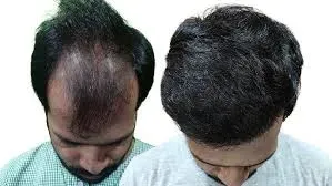 Hair Transplantation service image
