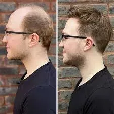  Non-Surgical Hair Replacement service image