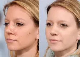 Laser Mole Remover Treatment service image