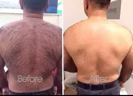  Laser Hair Removal Back Treatments service image