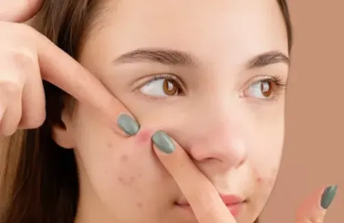 Acne Treatment in Coimbatore service image