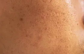 Open Pores Treatment In Coimbatore service image