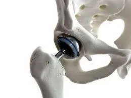 Joint Replacement service image