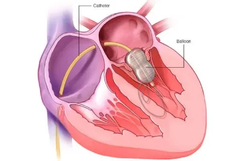 Balloon Mitral Valvotomy service image