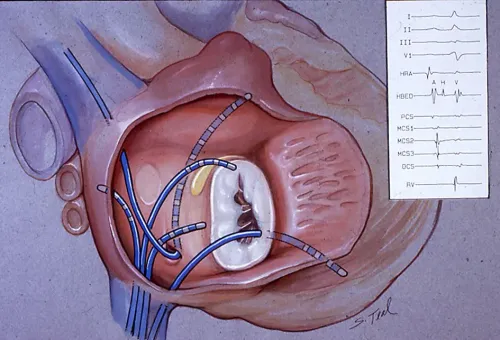 Electrophysiological Study (EP study) service image