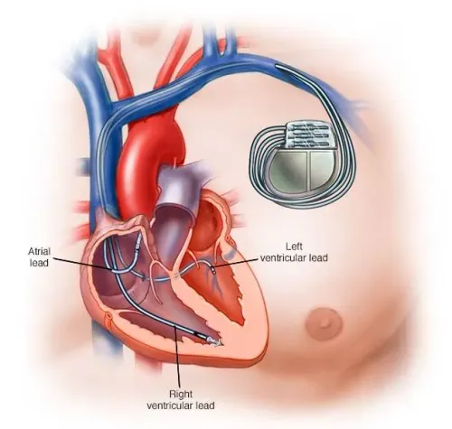 Pacemaker Implantation service image