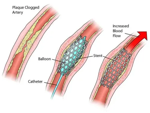 Angioplasty and Stent placement service image
