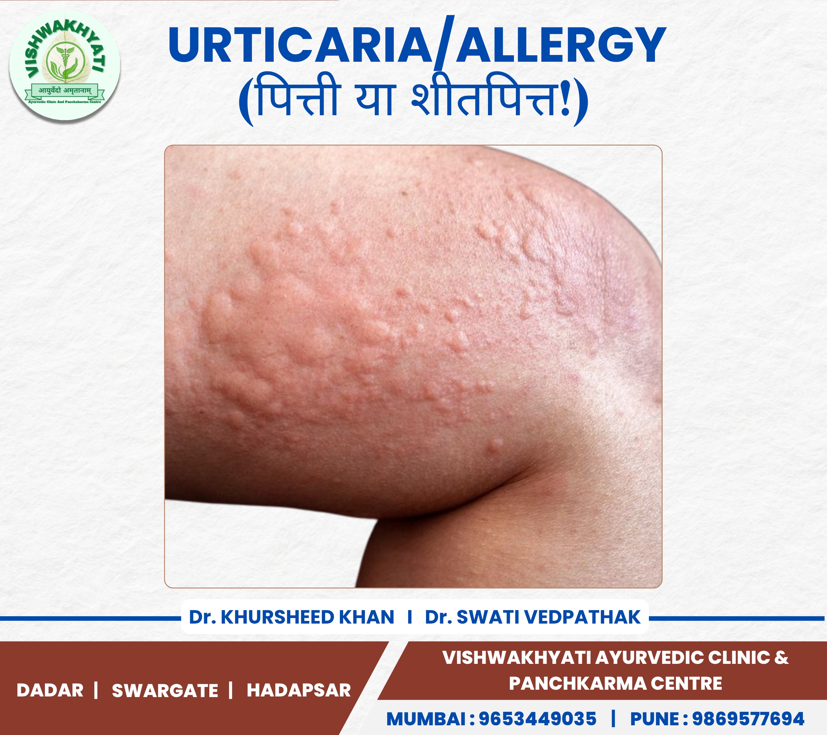 Urticaria/