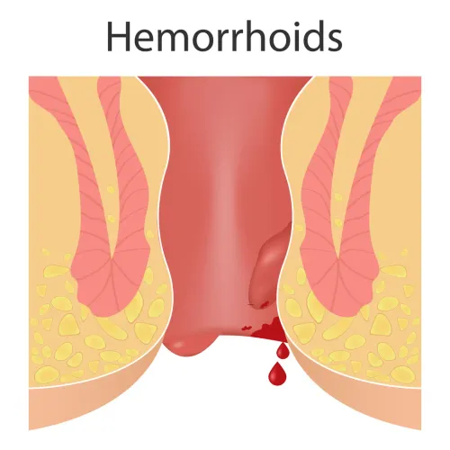 Piles & Hemorroids service image