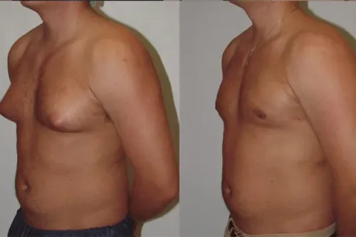 Gynecomastia service image