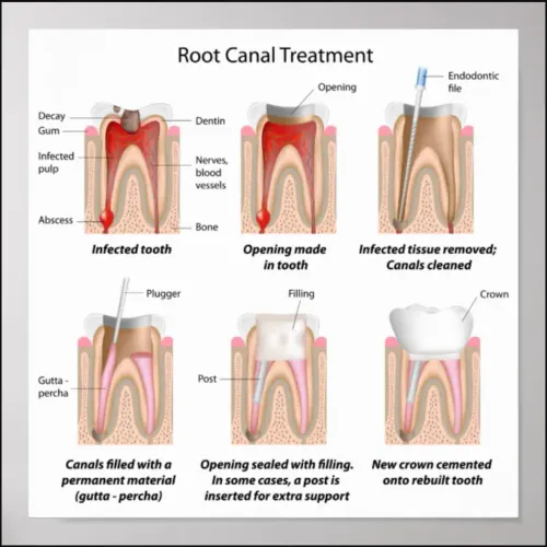 Root Canal Treatment service image