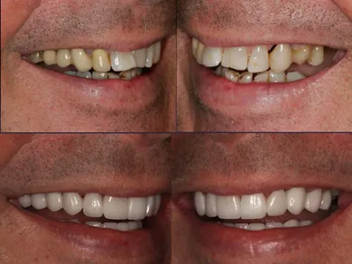 Full-Mouth Rehabilitation service image