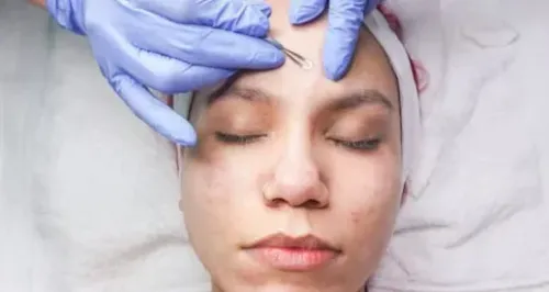 Acne treatment Coimbatore service image