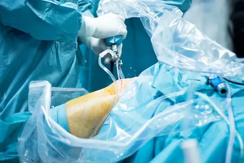 MINIMALLY INVASIVE JOINT SURGERIES/ARTHROSCOPY service image