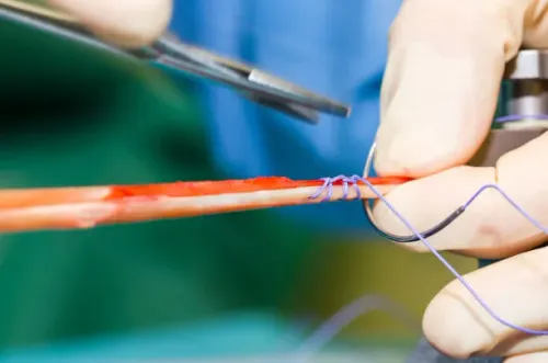 ACL Reconstruction Surgery service image