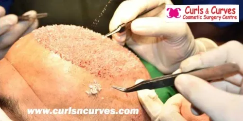 FUE Hair Transplant service image