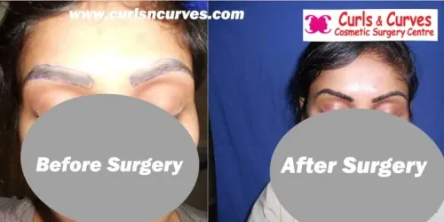 Eyebrow Hair Transplant service image