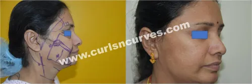Face Liposuction service image