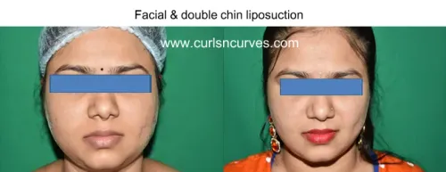 Chin Implant Surgery service image