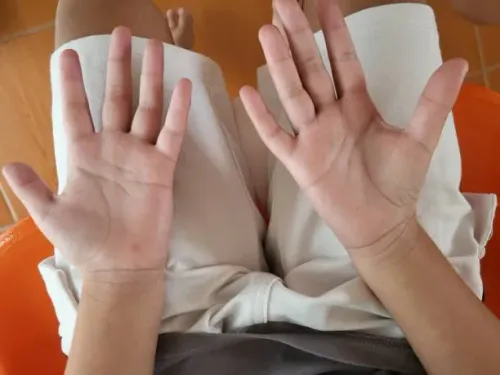 Congenital & Acquired Hand Deformities service image