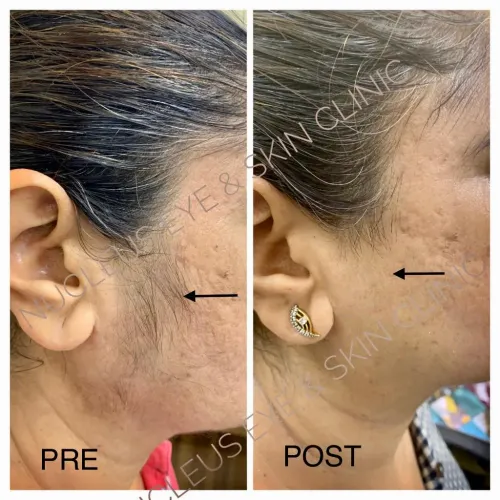 Laser hair reduction service image