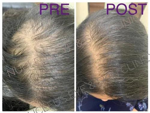 Hair growth with Hair PRP service image