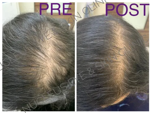 Platelet Rich Plasma therapy service image