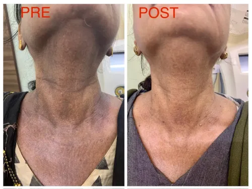 Q switch laser - for pigmentation service image