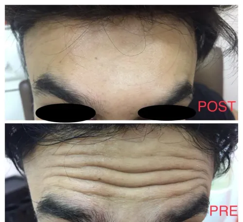 Anti-wrinkle injections service image