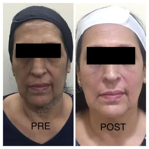 Dermal Fillers service image