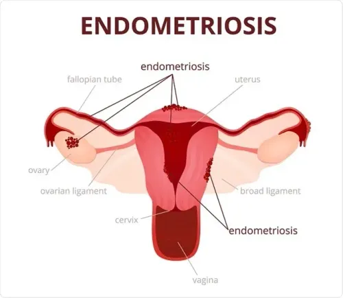 Endometriosis service image