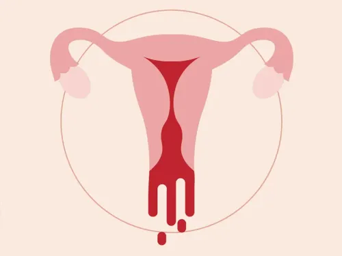 Heavy menstrual bleeding  service image