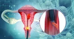 ENDOMETRIOSIS  service image