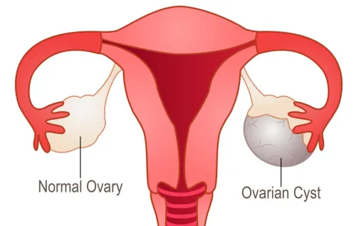 Ovarian cyst service image