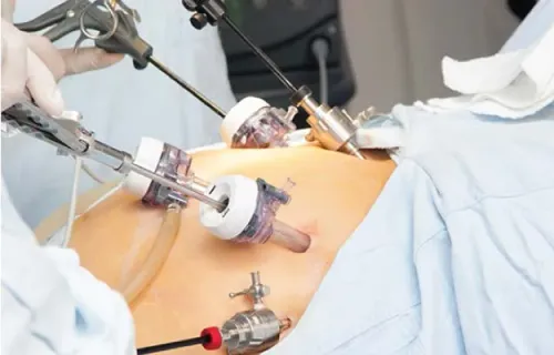 Laproscopic surgeries  service image