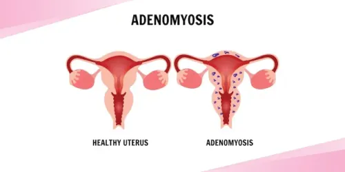 Adenomyosis service image