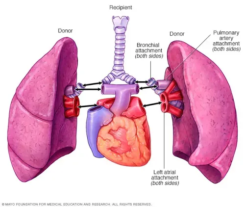 Lung Transplantation (Single & Double Lung) service image