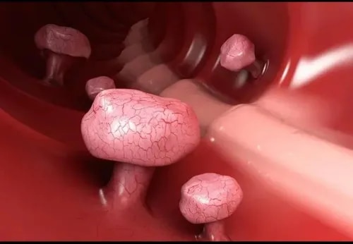 Treatment For Rectal Polyps service image