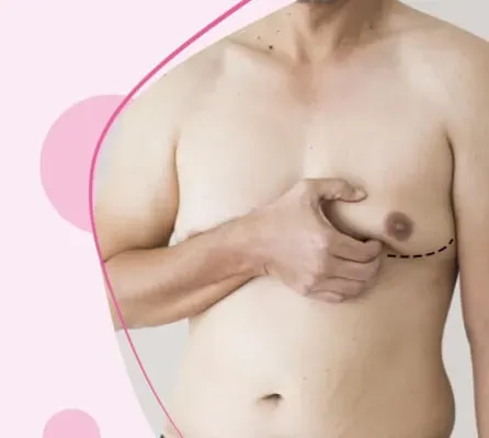 Gynecomastia Surgery (Male Breast  Reduction) Specialist in Pune service image