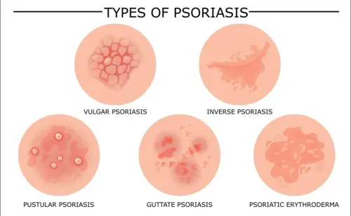 Psoriasis Treatment Specialist in Bibwewadi, Kondhwa, Dhankawadi, Pune service image