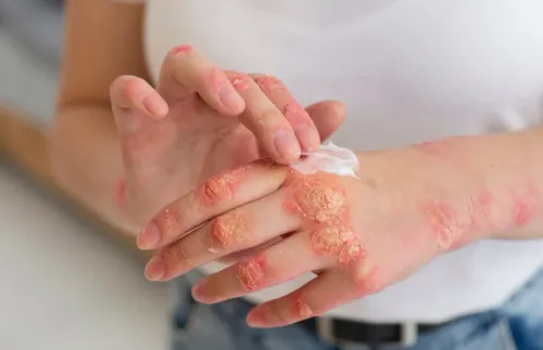 Eczema Treatment Specialist in Bibwewadi, Kondhwa, Dhankawadi, Pune  service image