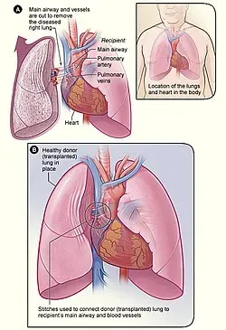 Pre- and Post-Lung Transplant Care service image