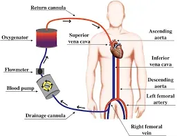 ECMO (Extracorporeal Membrane Oxygenation) Support service image