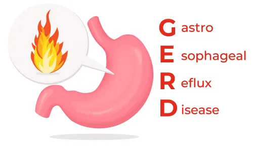 Acid Reflux Treatment - GERD  service image