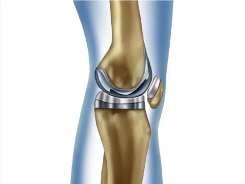 Knee Replacement service image