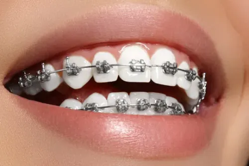 Braces service image