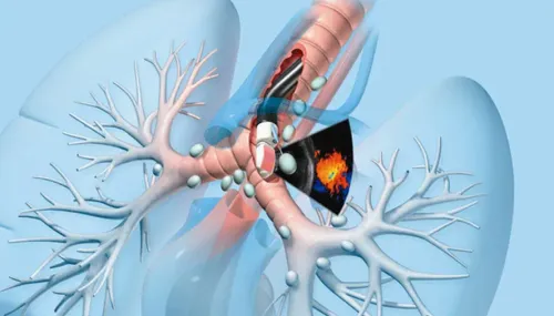 EBUS-TBNA (Endobronchial Ultrasound-Guided Transbronchial Needle Aspiration) service image